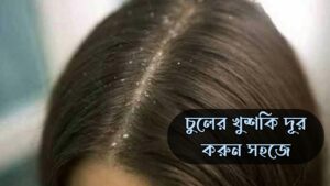 চুলের খুশকি দূর করার উপায়